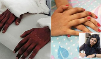 Picture Woman Amputee’s Transplanted “Male Hands” Turn Feminine, Stuns the Experts