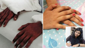 Picture Woman Amputee’s Transplanted “Male Hands” Turn Feminine, Stuns the Experts