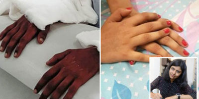 Picture Woman Amputee’s Transplanted “Male Hands” Turn Feminine, Stuns the Experts