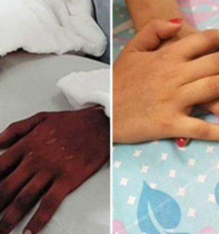 Picture Woman Amputee’s Transplanted “Male Hands” Turn Feminine, Stuns the Experts