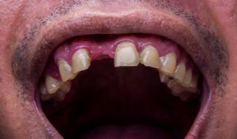 Picture Do You Dream About Teeth Falling Out? Here’s What It Means!