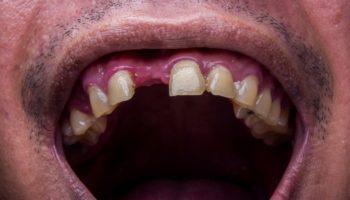 Picture Do You Dream About Teeth Falling Out? Here’s What It Means!