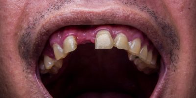 Picture Do You Dream About Teeth Falling Out? Here’s What It Means!