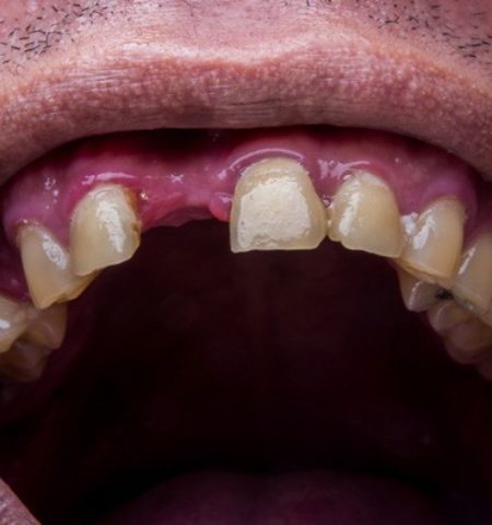 Picture Do You Dream About Teeth Falling Out? Here’s What It Means!