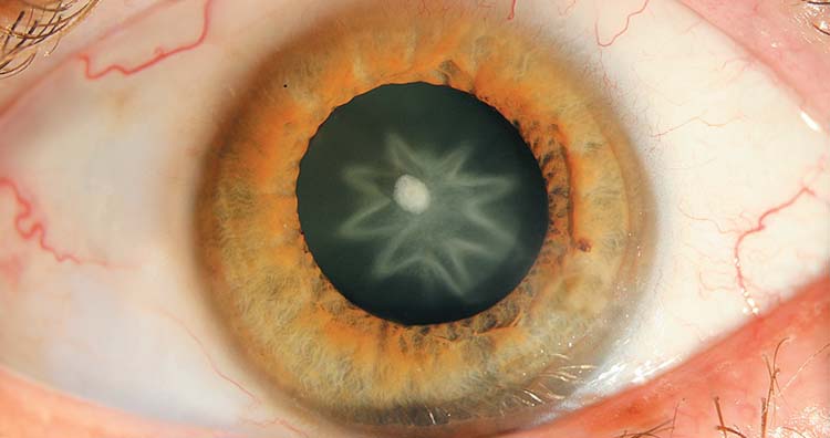 Rosette-shaped cataract