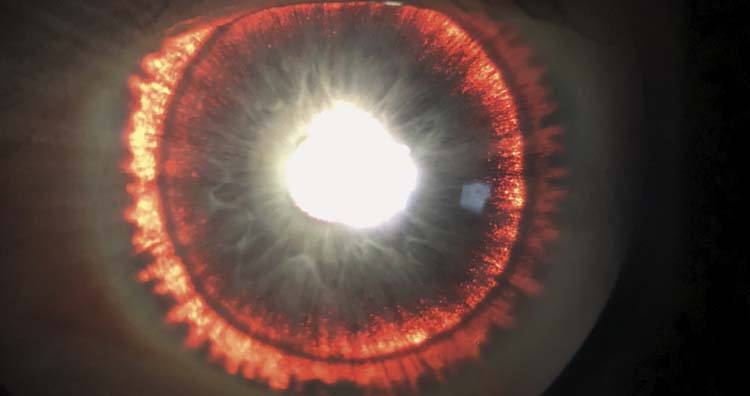 Iris Transillumination Defects
