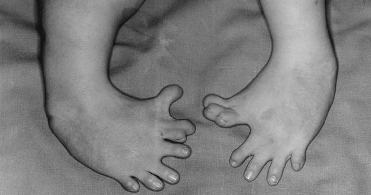 Effects of maternal drugs - thalidomide. 