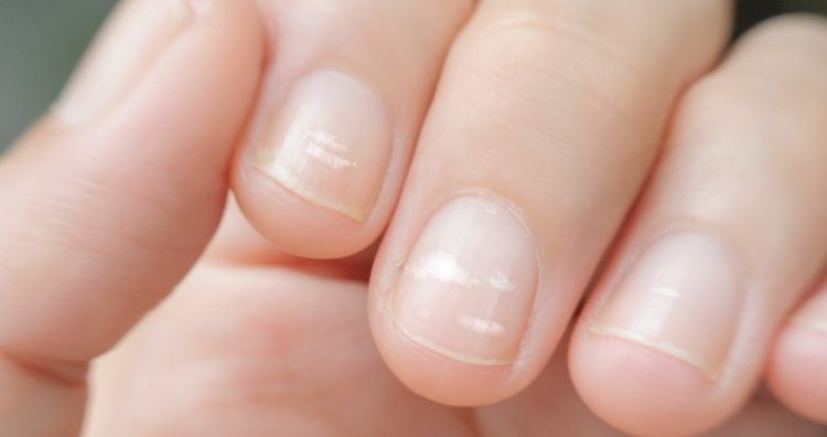 White spots on nails 