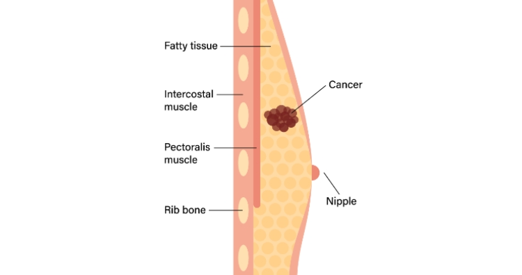 Male breast cancer
