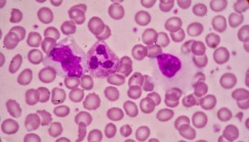 Picture A Man Named John Moore Was Treated By A Ucla Cancer Researcher, Who Developed And Commercialized His Cancer Cells Into A Cell Line