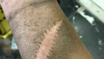 Picture Scar Tissue Has No Sweat Glands or Hair Follicles