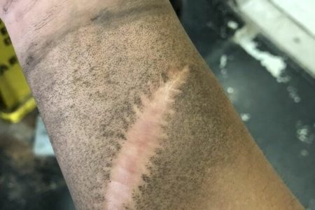 Picture Scar Tissue Has No Sweat Glands or Hair Follicles