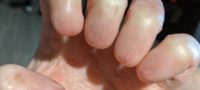 Picture Anonychia – A Rare Condition Marked by an Absence of Fingernails and Toenails
