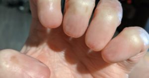 Anonychia – A Rare Condition