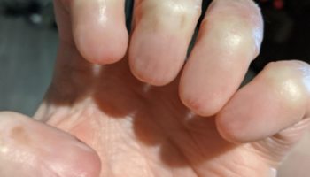 Picture Anonychia – A Rare Condition Marked by an Absence of Fingernails and Toenails