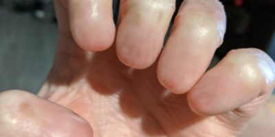 Picture Anonychia – A Rare Condition Marked by an Absence of Fingernails and Toenails