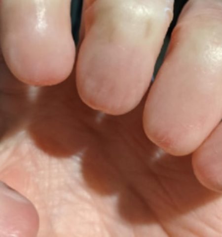 Picture Anonychia – A Rare Condition Marked by an Absence of Fingernails and Toenails
