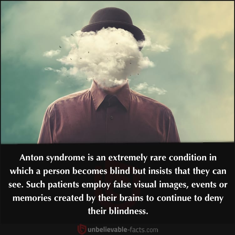 Anton syndrome