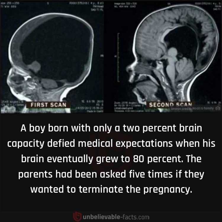 Boy Born with Only a Two Percent Brain