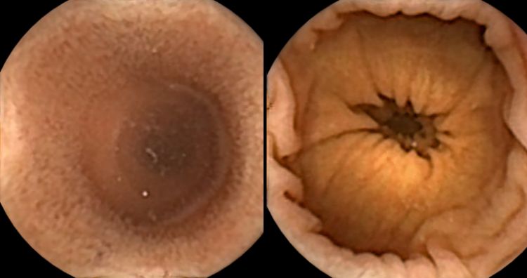 Images taken by capsule endoscopy