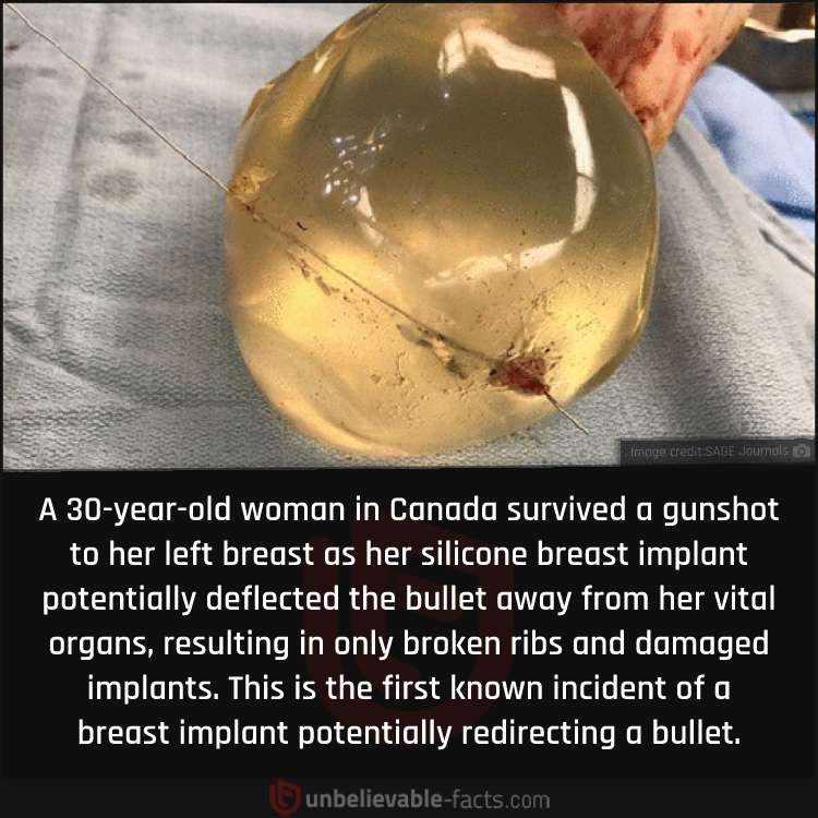 Woman's breast implant possibly deflects bullet