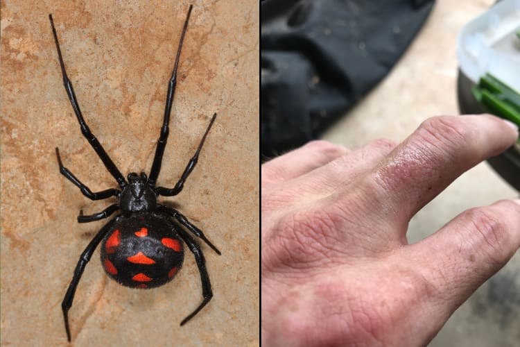 Black widow spider bite