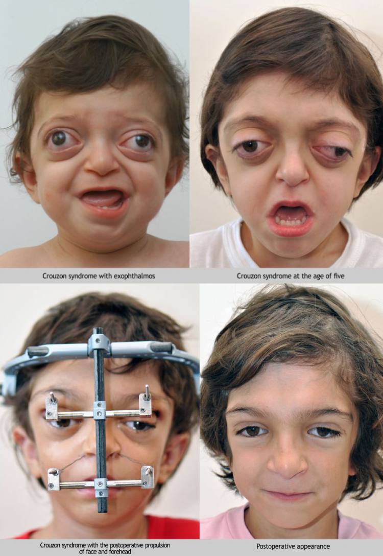 before and after crouzon syndrome