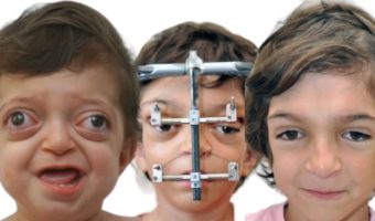 Picture Crouzon Syndrome Patients Showcase Successful Plastic Correction Outcomes