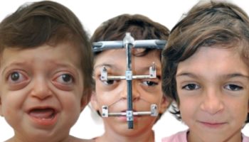 Picture Crouzon Syndrome Patients Showcase Successful Plastic Correction Outcomes