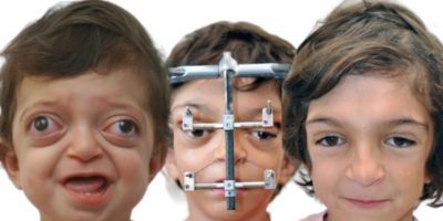 Picture Crouzon Syndrome Patients Showcase Successful Plastic Correction Outcomes
