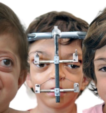 Picture Crouzon Syndrome Patients Showcase Successful Plastic Correction Outcomes