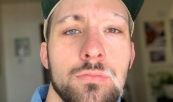 Picture This Man with Vitiligo and Heterochromia Has Embraced His Imperfections in Style!