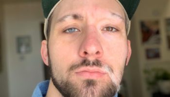 Picture This Man with Vitiligo and Heterochromia Has Embraced His Imperfections in Style!