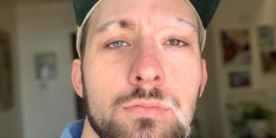 Picture This Man with Vitiligo and Heterochromia Has Embraced His Imperfections in Style!