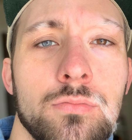 Picture This Man with Vitiligo and Heterochromia Has Embraced His Imperfections in Style!