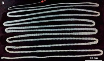 Picture Chinese Man Discovers 20-Foot Tapeworm After Years of Consuming Raw Beef