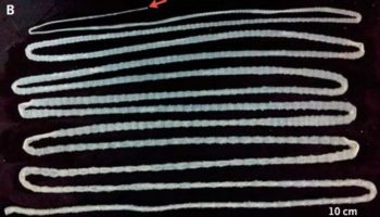 Picture Chinese Man Discovers 20-Foot Tapeworm After Years of Consuming Raw Beef