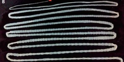 Picture Chinese Man Discovers 20-Foot Tapeworm After Years of Consuming Raw Beef