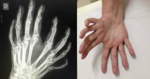 What is Mirror Hand? A congenital disease that's rare & strange