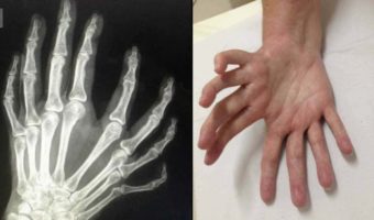 Picture “Mirror Hand,” the Rare Condition Resulting in Hand Duplication