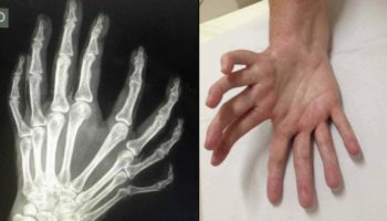 Picture “Mirror Hand,” the Rare Condition Resulting in Hand Duplication