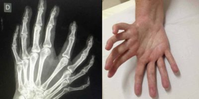 Picture “Mirror Hand,” the Rare Condition Resulting in Hand Duplication