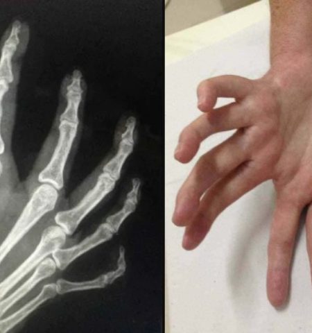 Picture “Mirror Hand,” the Rare Condition Resulting in Hand Duplication