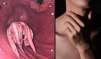 Picture Doctors Horrified to Find an Octopus Stuck in a Man’s Throat in Singapore!