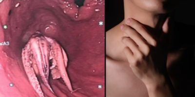 Picture Doctors Horrified to Find an Octopus Stuck in a Man’s Throat in Singapore!