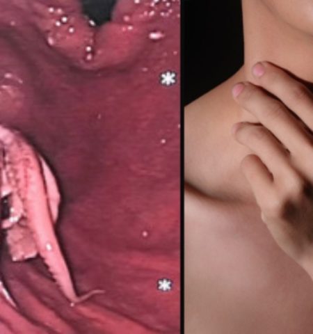 Picture Doctors Horrified to Find an Octopus Stuck in a Man’s Throat in Singapore!