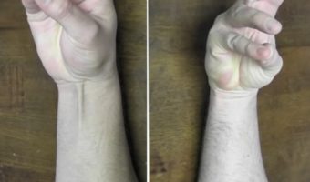 Picture Why Do Some People Not Have Palmaris Longus Muscles?