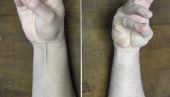 Picture Why Do Some People Not Have Palmaris Longus Muscles?