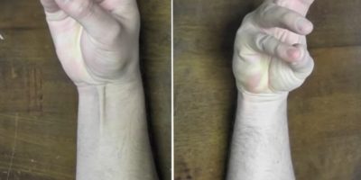 Picture Why Do Some People Not Have Palmaris Longus Muscles?