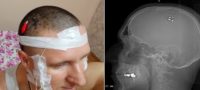 Picture Mikhail Raduga Claims to Have Implanted a Chip in His Head to Control Lucid Dreams